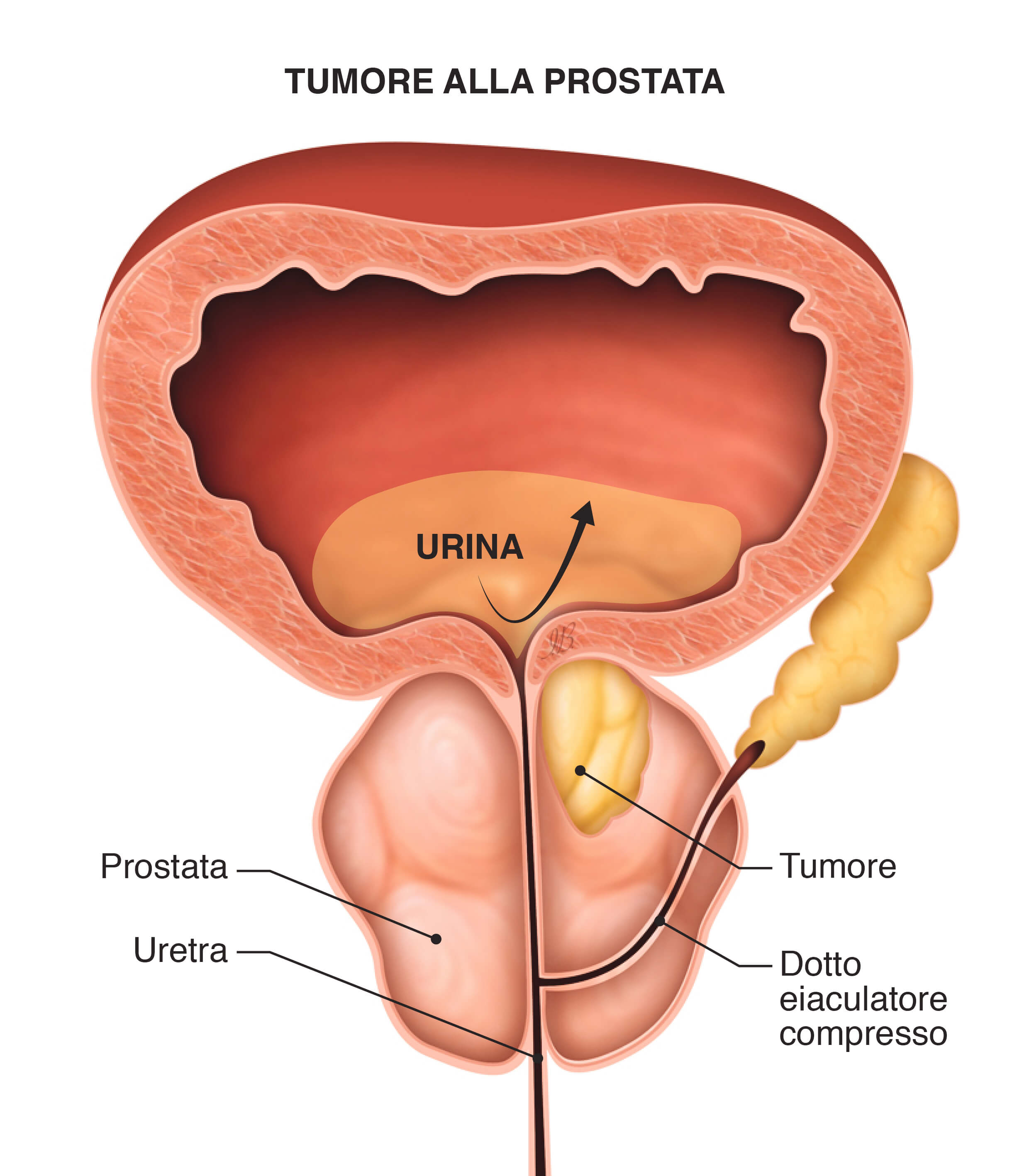 la prostata è un tumore