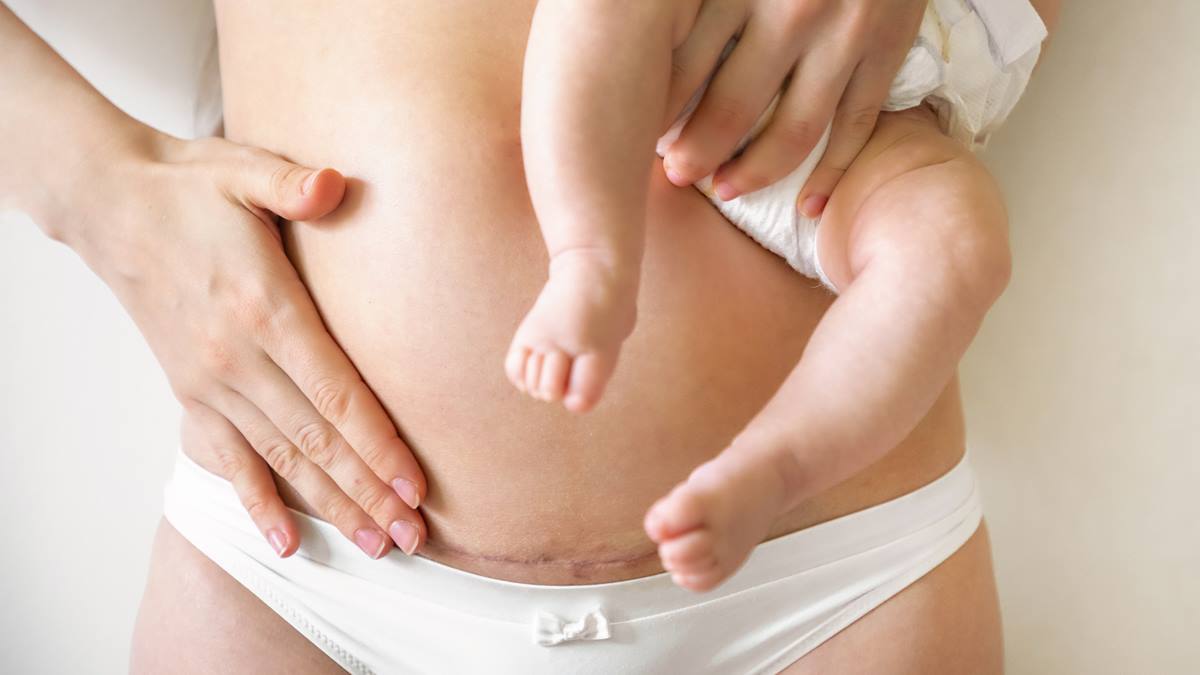 trattamento cicatrici post parto