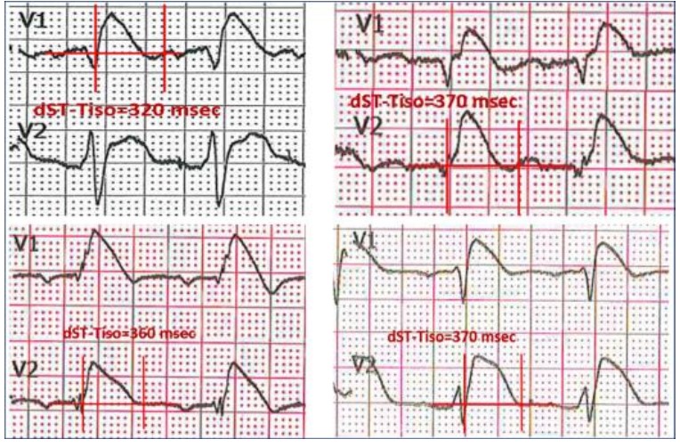 Un elettrocardiogramma con aspetto tipico dST-Tiso