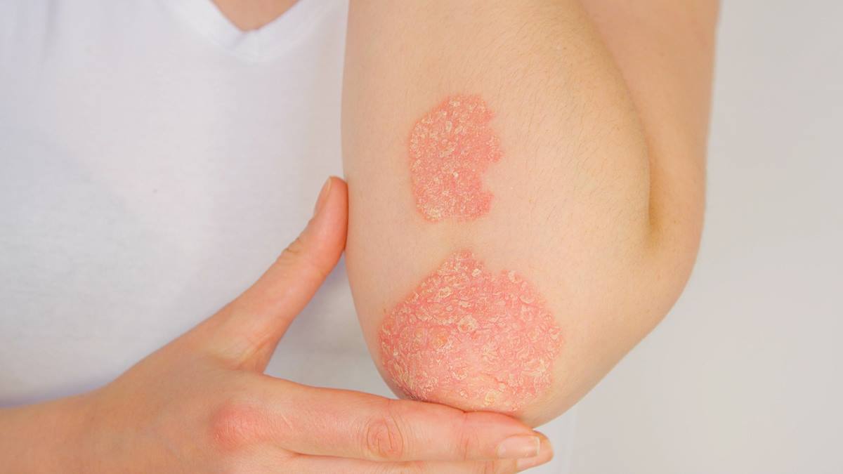 artrite psoriasi prevenzione forli primus