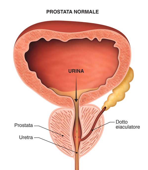 tumore prostata sintomi e cure)